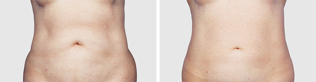 Before and After CoolSculpting Procedure