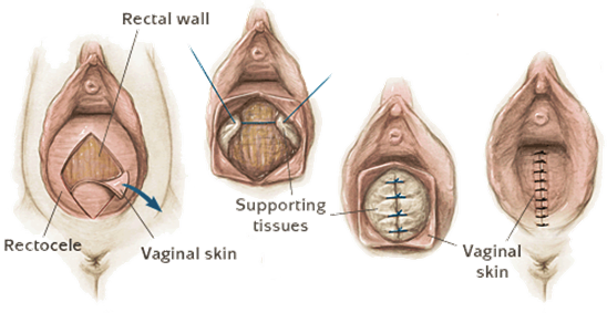 vaginal repair animation