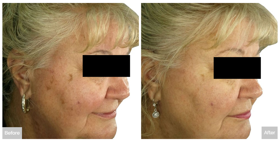 Tribella Before and After