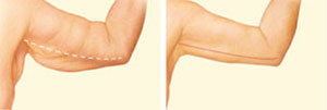 Inner Arm Incision Before and After Arlington
