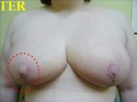 Breast Reduction