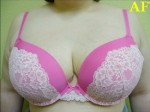 Breast Reduction