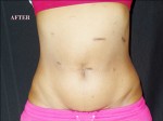 CoolSculpting