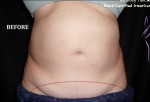 CoolSculpting