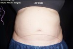 CoolSculpting