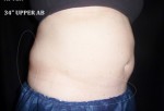 CoolSculpting