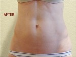 CoolSculpting