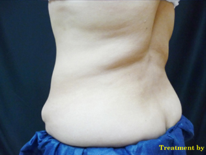 CoolSculpting