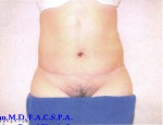 Tummy Tuck