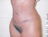 Tummy Tuck