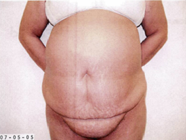 Tummy Tuck Case 3675 Before Photo Tummy Tuck