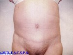 Tummy Tuck