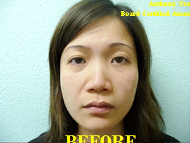 Nose Surgery Case 3691 Before Photo Nose Surgery