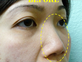 Nose Surgery Case 3691 Before Photo Nose Surgery