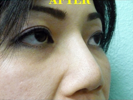 Nose Surgery Case 3691 After Photo Nose Surgery