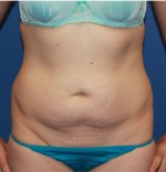 Tummy Tuck