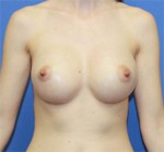 Breast Augmentation