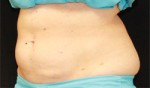 CoolSculpting