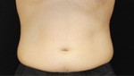 CoolSculpting