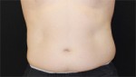 CoolSculpting