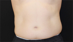 CoolSculpting Case 4206 After Photo CoolSculpting