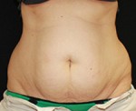 CoolSculpting