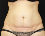 CoolSculpting