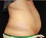 CoolSculpting