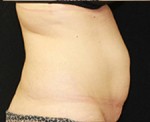 CoolSculpting