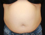 CoolSculpting