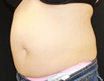 CoolSculpting