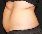 CoolSculpting