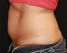 CoolSculpting Case 4236 After Photo CoolSculpting