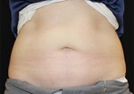 CoolSculpting