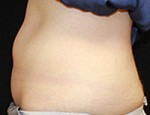 CoolSculpting