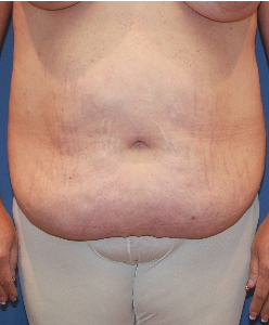 Liposuction