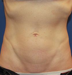 Arlington Mini Tummy Tuck Before and After Photos - Texas Plastic