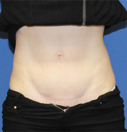 Arlington Mini Tummy Tuck Before and After Photos - Texas Plastic