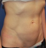 Arlington Mini Tummy Tuck Before and After Photos - Texas Plastic