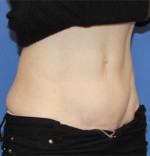 Mini Tummy Tuck