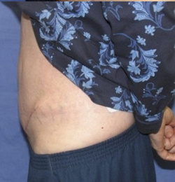 Mini Tummy Tuck