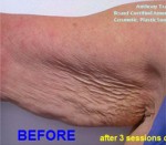 Arms Wrinkles Removal