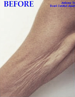 Arms Wrinkles Removal
