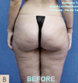 Cellulite Removal