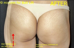 Cellulite Removal