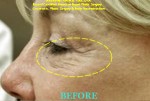 Eye Wrinkles Removal