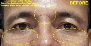 Eye Wrinkles Removal