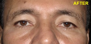 Eye Wrinkles Removal