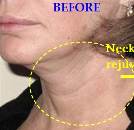 Neck Lifts