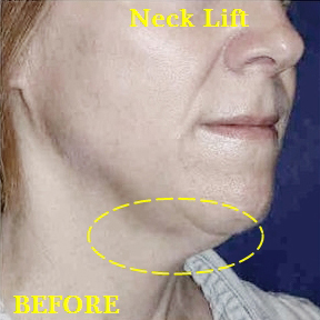 Neck Lifts